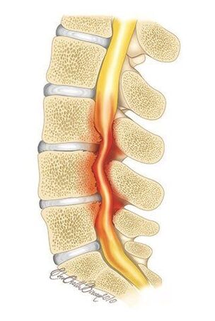 Ar mugurkaula krūšu kurvja osteohondrozi rodas mugurkaula kanāla saspiešana