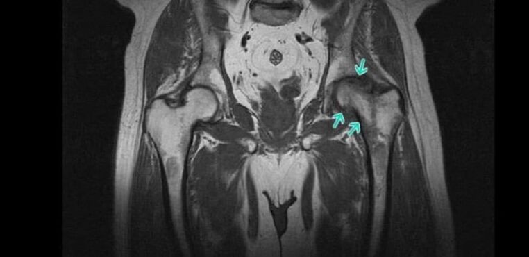 Gūžas locītavas osteoartrīts uz MRI