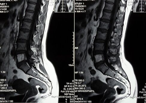 Mugurkaula jostas-krustu daļas MRI, lai diagnosticētu muguras sāpes